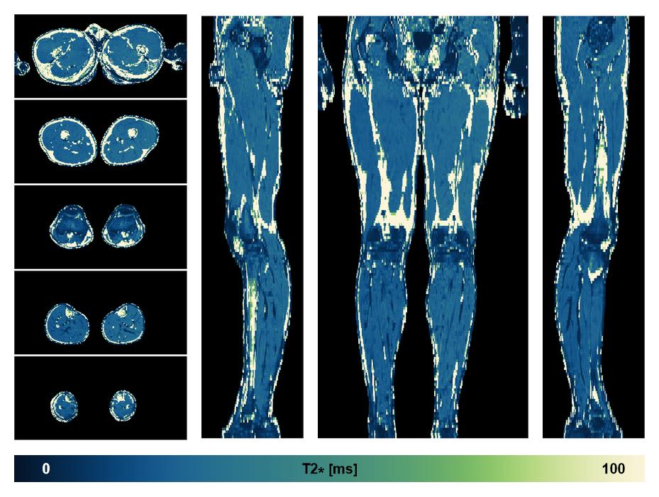 The T2 star relaxation time of the lower extremity obtained from the dixon reconstruction for muscle water fat quantification.